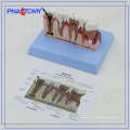 PNT-0528 Modèle de dents dentaires à haut grade parodontal